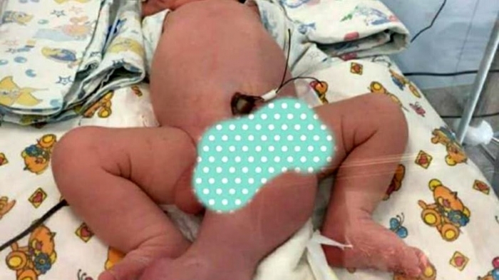 üç bacaklı iki penisli olarak dünyaya gelen bebek