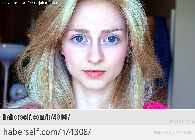 Saç Baş Yolduran Hastalık: Trichotillomania'dan Muzdarip Genç Kızın 11 Fotoğrafı