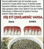 diş eti çekilmesi / #2120732