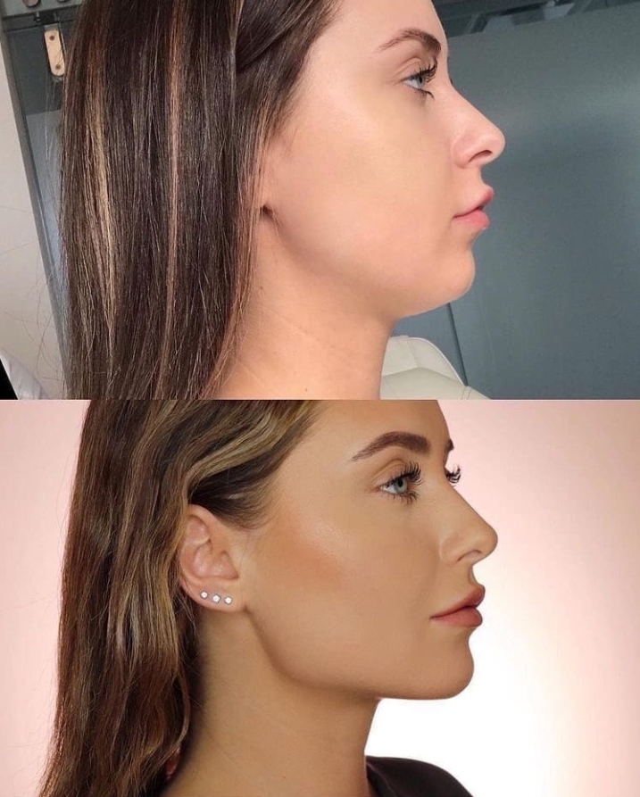 Jawline 2023404 Uluda S zl k Galeri