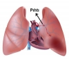 pulmoner emboli / #2148836