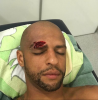 felipe melo nun kaşının yarılması / #1343637